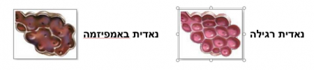מה זה COPD - מחלה ריאתית חסימתית כרונית?