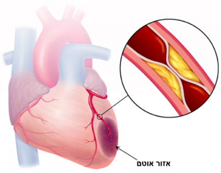 ‫חשד לאירוע קורונרי חריף‬ - ACS