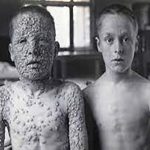 תמונה מלפני 100 שנים, ילד מחוסן וילד לא מחוסן כנגד אבעבועות שחורות