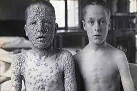 תמונה מלפני 100 שנים, ילד מחוסן וילד לא מחוסן כנגד אבעבועות שחורות